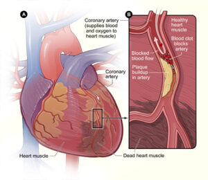 cardiac arrest