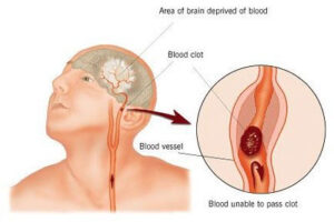 People with which blood group are at greater risk of stroke?