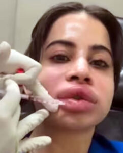 Fans panicked after seeing Urfi Javed's face and lips badly swollen